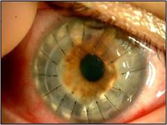 Córnea y superficie ocular