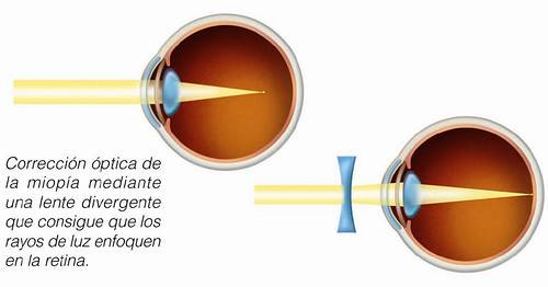 Defectos ópticos - Clínica oftalmológica