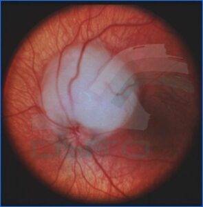 Fig 1. Aparece en la retina pero con el crecimiento afecta a todo el globo ocular y puede producir metástasis